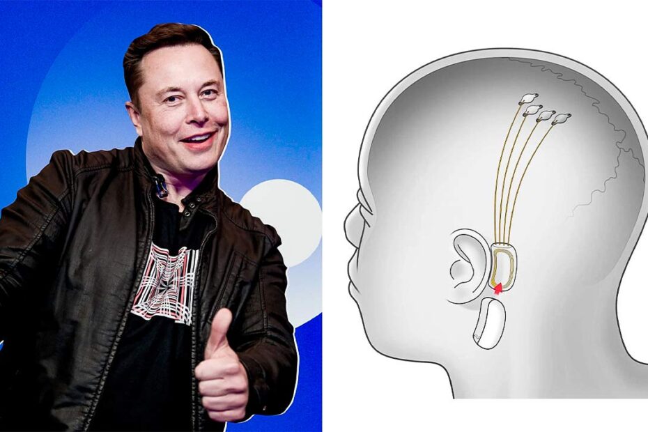 Elon Musk Says 6 Months to First Human Implant of Brain Interface